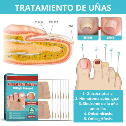 PARCHES ANTIHONGOS PARA UÑAS - ¡Mejora su apariencia en solo días!